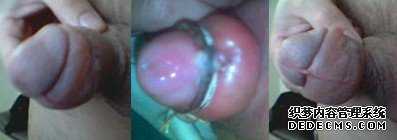 包皮手術(shù)后水腫圖片是什么樣的