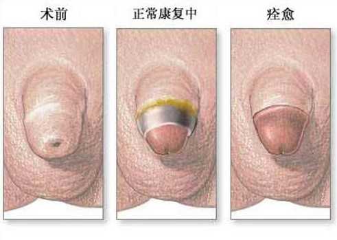 包皮過長的圖譜